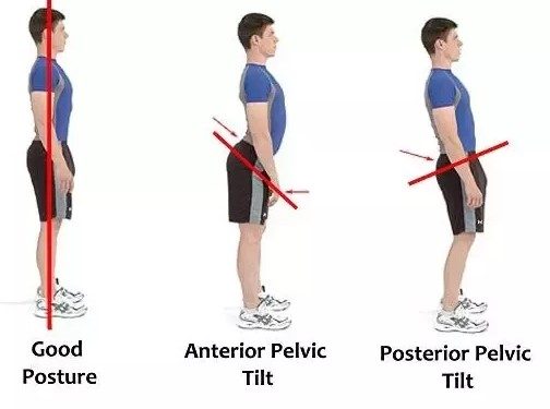 How Do You Know If You Have An Anterior Pelvic Tilt